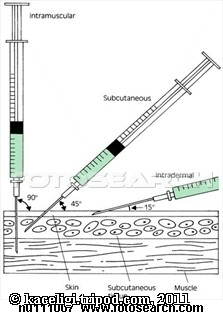 intradermal injection technique