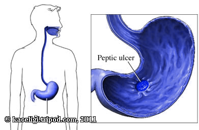 holistic treatment of peptic ulcer