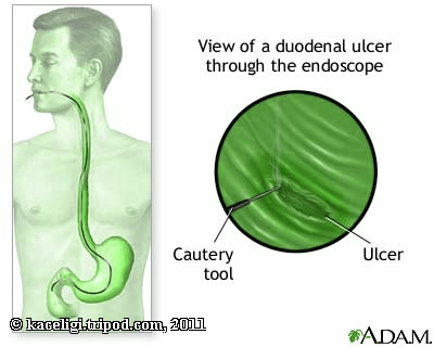 peptic ulcer with lung